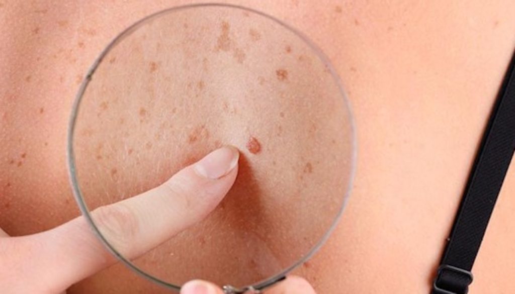 Skin Pigmentation Disorders