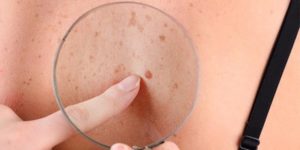 Skin Pigmentation Disorders