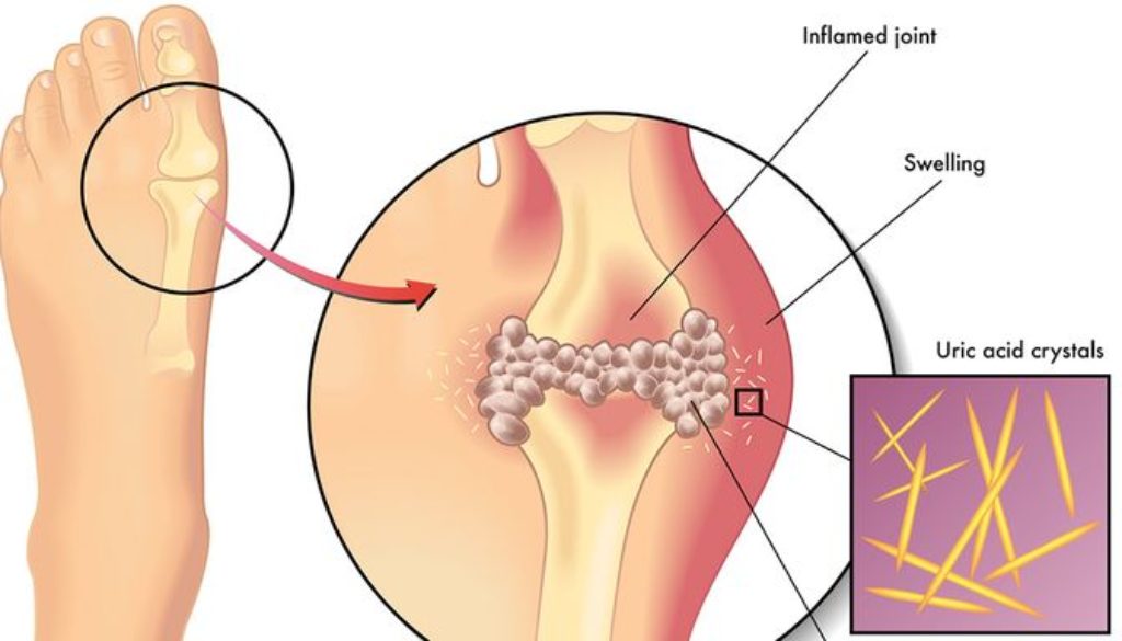 Uric acid disease (Gout)