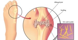 Uric acid disease (Gout)