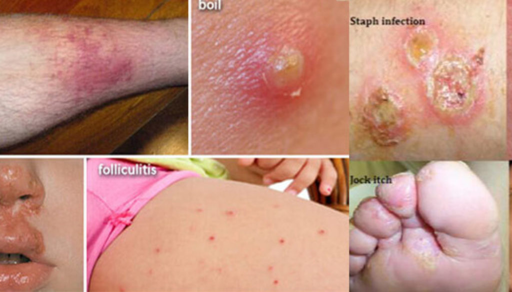 Skin diseases and infections