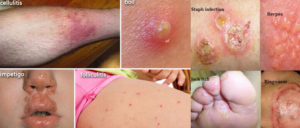 Skin diseases and infections