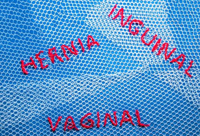 hernia image